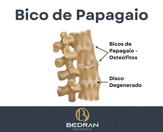 O que é bico de papagaio ou osteofitose? Saiba tudo sobre a doença